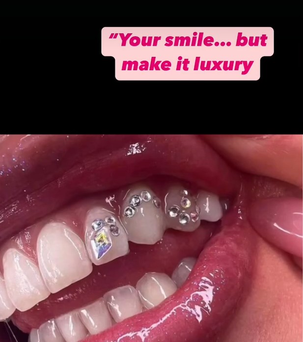 Close-up of crystal tooth gems applied to a bright smile